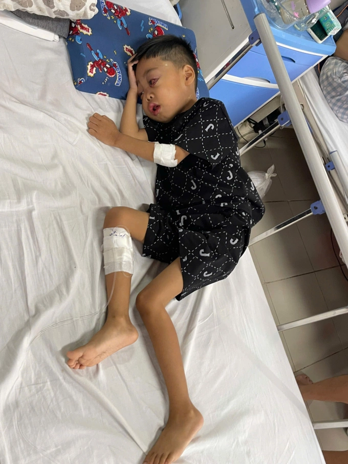 Hoàng Anh, 6 tuổi ở phường Đông Hà, tỉnh Quảng Trị đang điều trị ung thư máu tại bệnh viện Trung ương Huế, tháng 7/2025. Ảnh: Nhân vật cung cấp