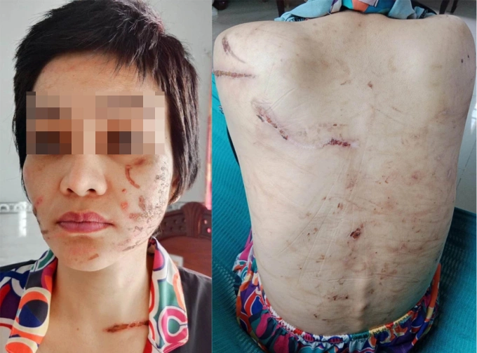 Nạn nhân Giao người chi chít vết thương sau khi bị chồng bạo hành như thời trung cổ. Ảnh: Gia đình cung cấp