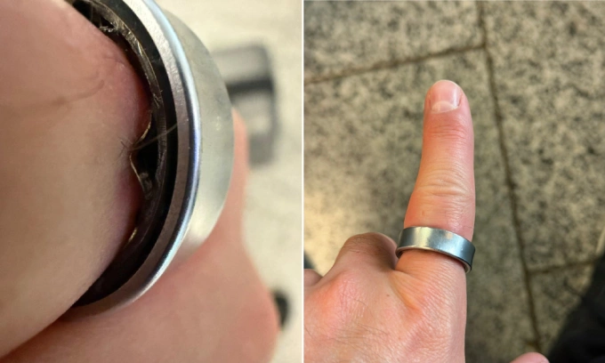 Nhẫn Galaxy Ring biến dạng và mắc kẹt trên ngón tay Daniel Rotar. Ảnh: X/Daniel Rotar