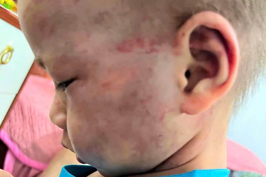 Cha dượng bị tạm giữ do đánh bé 3 tuổi 'chấn động não'