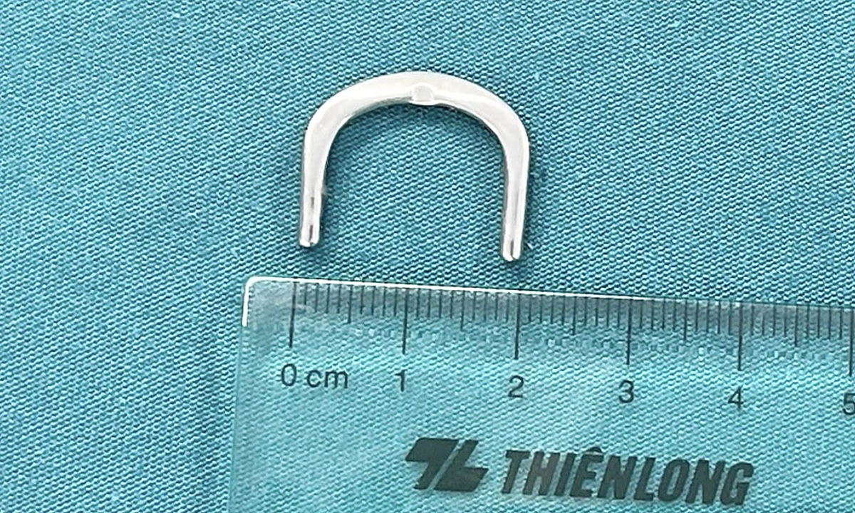 Móc khóa đồng hồ mắc kẹt tại tá tràng bé 3 tuổi