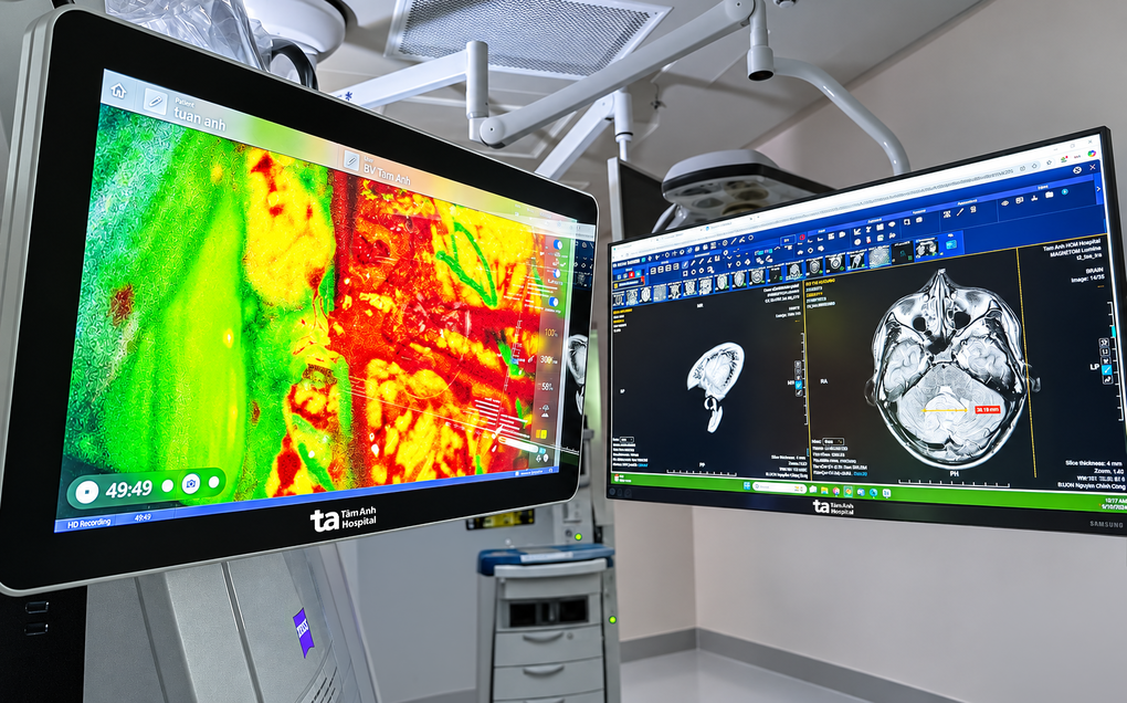 Vùng mô u tích lũy fluorescein phát sáng huỳnh quang (trái) và đối chiếu với hình ảnh MRI chụp não người bệnh (phải). Ảnh: Bệnh viện Tâm Anh